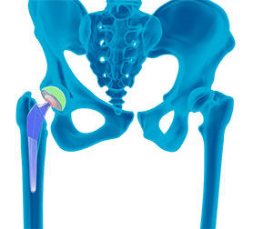 Robotic Total Knee Replacement Anatomy