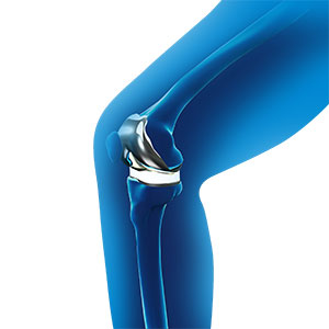 Picture of Robotic Total Knee Replacement