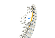 Cervical Laminectomy and Fusion