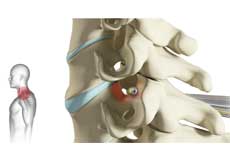 Cervical Microdiscectomy