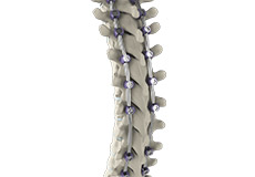 Complications of Spinal Surgery