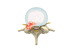 Herniated Disc (Cervical)