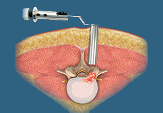 Microscopic Spine Surgery