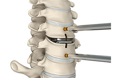 Motion-Sparing Surgery