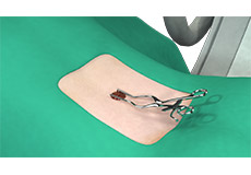 Outpatient Spine Surgery