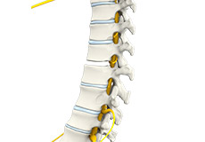 Spinal Fusion