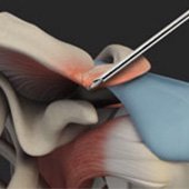 AC Joint Stabilization