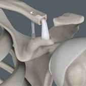 Acromioclavicular (AC) Joint Reconstruction