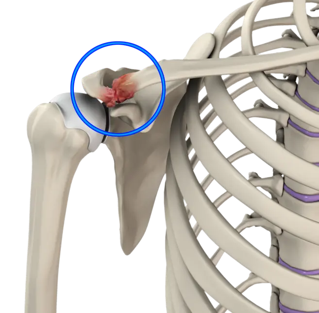 Acromioclavicular AC Joint Osteoarthritis