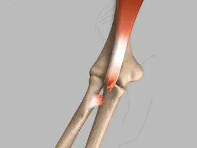 Bicep Tendon Tear at the Elbow