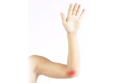 Cubital Tunnel Syndrome