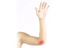 Cubital Tunnel Syndrome Ulnar Nerve Entrapment
