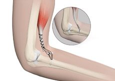 Distal Biceps Repair