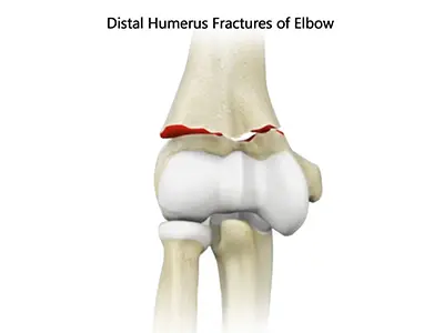 Distal Humerus Fractures of the Elbow