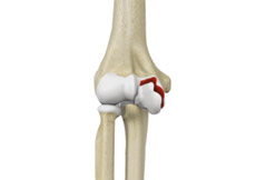 Distal Humerus Fractures of the Elbow