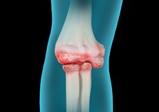 Elbow Arthritis
