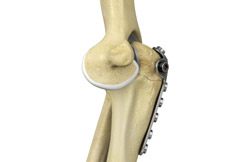 Elbow Fracture Reconstruction
