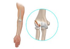 Elbow Injuries