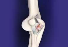 Elbow Ligament Reconstruction