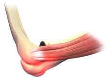 Elbow Sprain