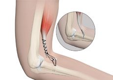 Elbow Tendon and Ligament Repair