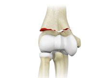 Elbow Trauma