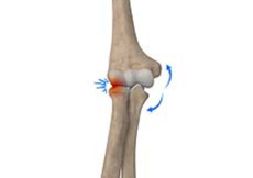 Lateral Impingement of the Elbow