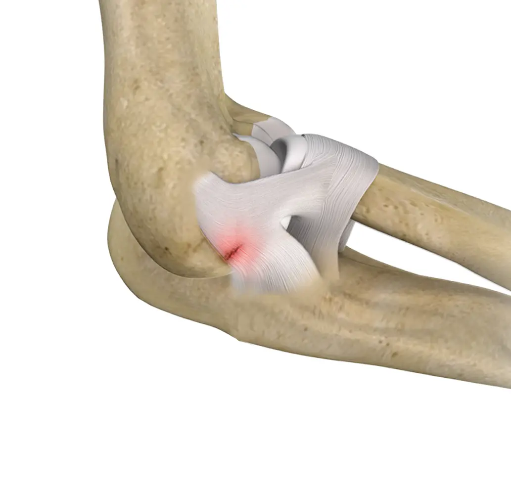 Lateral Ulnar Collateral Ligament Injuries of the Elbow