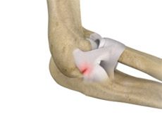 Lateral Ulnar Collateral Ligament Injuries