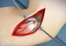 Open Elbow Surgery