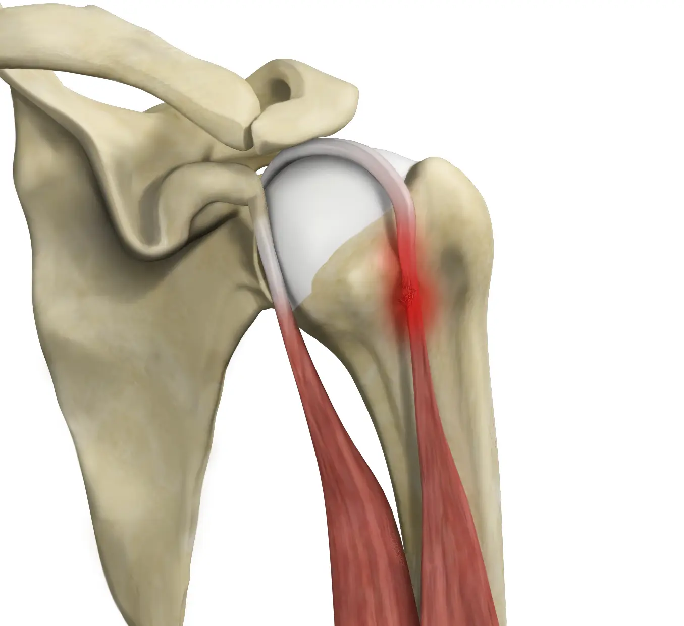 Proximal Biceps Tendonitis