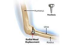 Radial Head Fractures of the Elbow