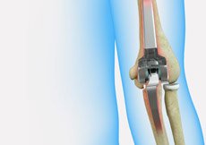 Revision Elbow Replacement