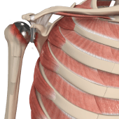 Revision Shoulder Replacement