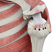Rotator Cuff Repair