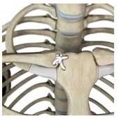 SC Joint Injury Reconstruction