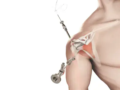 Shoulder Arthroscopy