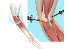 Tennis Elbow Surgery