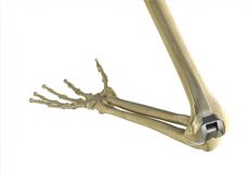 Total Elbow Replacement