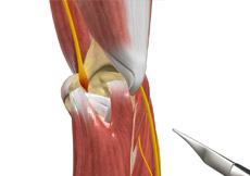 Ulnar Nerve Transposition