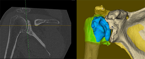 Mako Robotic Shoulder Replacement