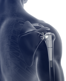 Mako Robotic Shoulder Replacement