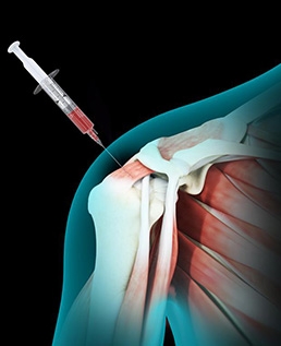 Platelet-Rich Plasma (PRP) Therapy for Rotator Cuff Injuries