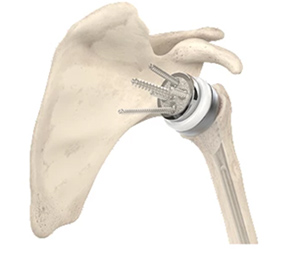 Reverse Shoulder Replacement with Mako SmartRoboticsâ„¢