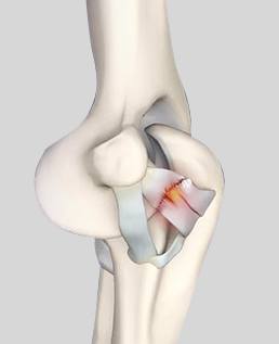 Ligament Reconstruction
