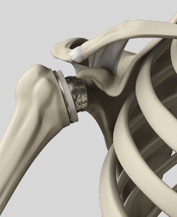 Reverse Shoulder Replacement