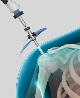 Shoulder Arthroscopy