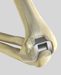 Total Elbow Replacement