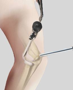 Elbow Arthroscopy