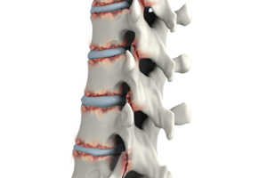 Ankylosing Spondylitis